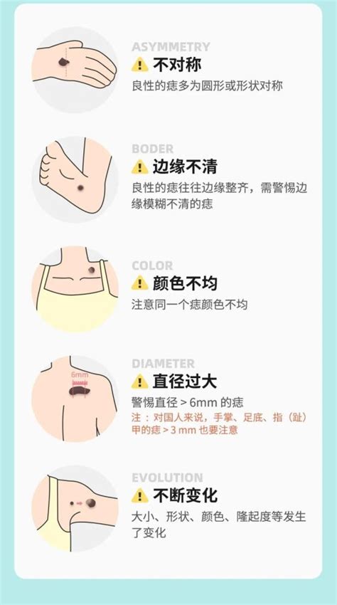 腋下有凸痣|痣也可能会癌变！长在 3 个地方要注意